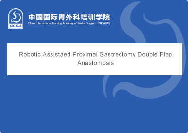 Robotic Assistaed Proximal Gastrectomy Double Flap Anastomosis
