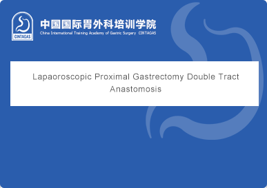 Lapaoroscopic Proximal Gastrectomy Double Tract Anastomosis